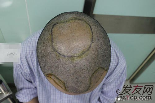 去科发源植发靠不靠谱呢?