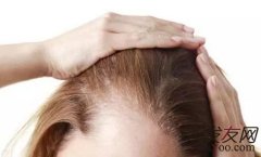 女性脱发严重应该挂什么科治疗？