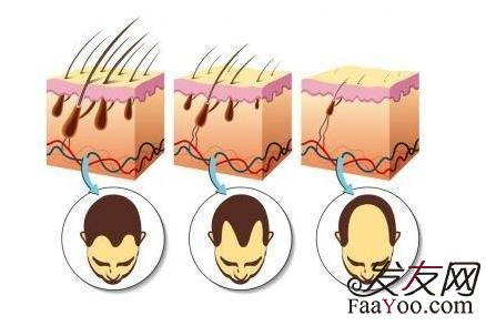 遗传性脱发早期怎么判断？