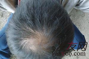 男性脱发较好不要吃哪些食物呢?