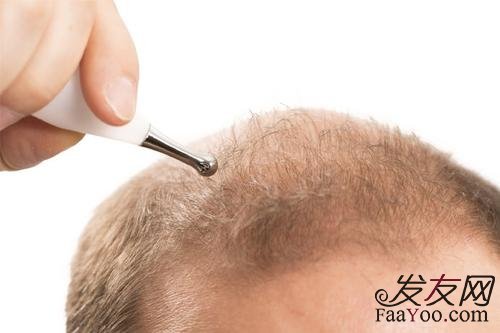 男性容易脱发和什么有关?