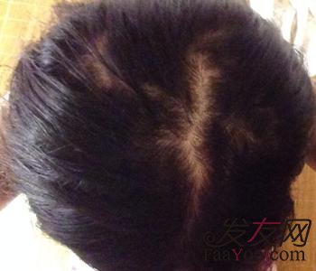 男性容易脱发和什么有关?
