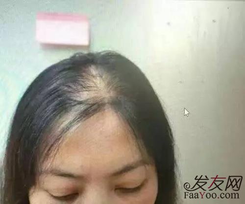 大量脱发和那些因素有关?