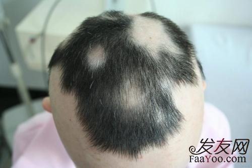 局部脱发的原因有哪些?