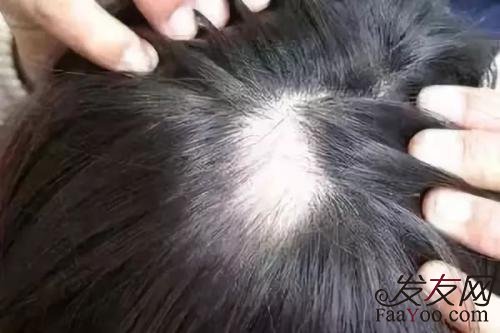 局部脱发的原因有哪些?
