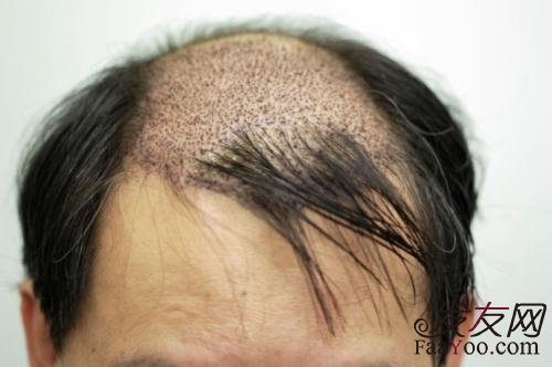 植发之后的后遗症真的存在吗？
