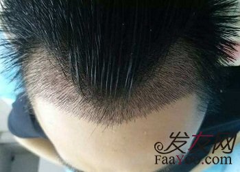 植发之后的后遗症真的存在吗?