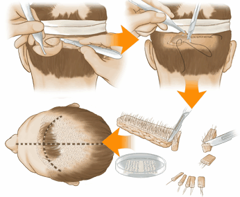 毛发移植全过程是怎样的？