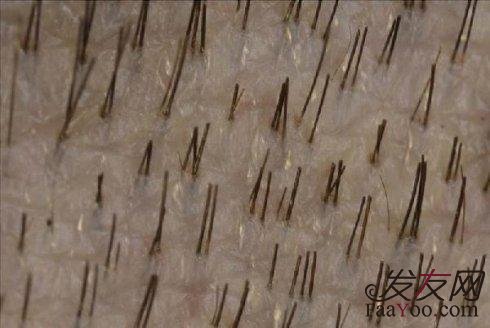 毛发移植全过程是怎样的?