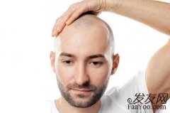 雄激素脱发治疗的原则是什么？