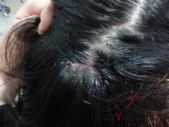  遗传脱发在什么时候显现出来？