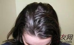 头上有头油怎么去除？