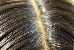 脂溢性脱发是遗传因素还是后天因素呢？