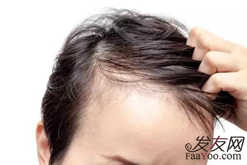 男生头发头油多怎么办?