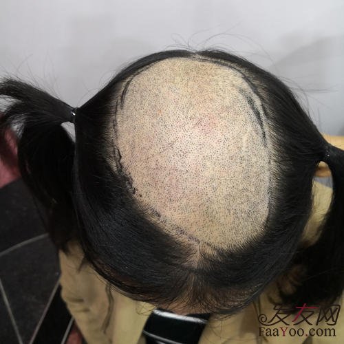 植发的时候我们必须剃头发吗?