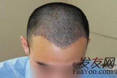 头发加密的价格贵吗？