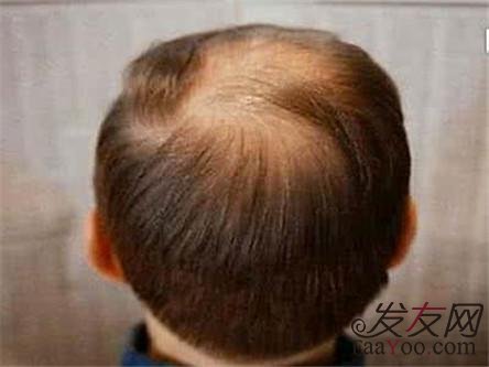 如何预防雄性脱发的发生呢