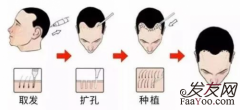 植发后期效果能维持多久？