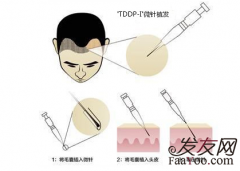 选择微针植发怎么样？
