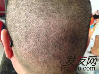 选择微针植发怎么样?