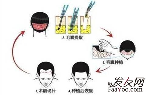 头发少的人可以选择植发吗?