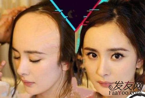 前额植发一般多少钱?