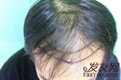 前额植发一般多少钱?