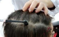 脱发严重了该怎样做治疗？