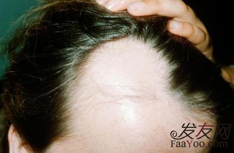 脂溢性脱发究竟是什么原因造成的?
