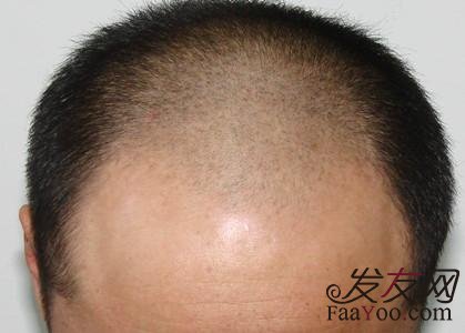秃顶的人应该怎么去植发呢?