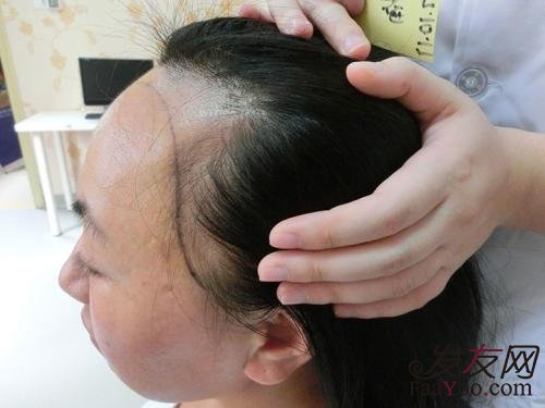 女性前额植发手术效果好吗？