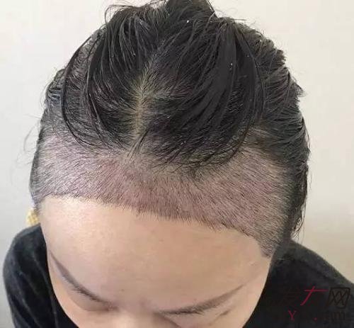 发线际植发能维持多久 ?