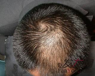 植发手术后注意事项都是什么?