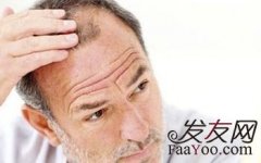 种植的头发牢固吗？