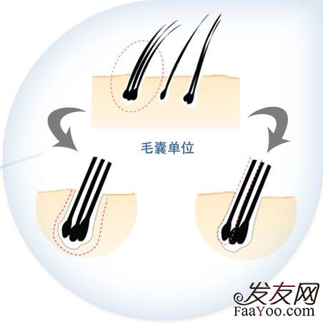 头发种植利弊有哪些?
