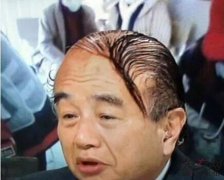 植发手术后恢复时间长吗？