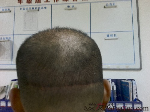 植发手术后恢复时间长吗?