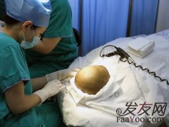 植发后多久可以出来效果？