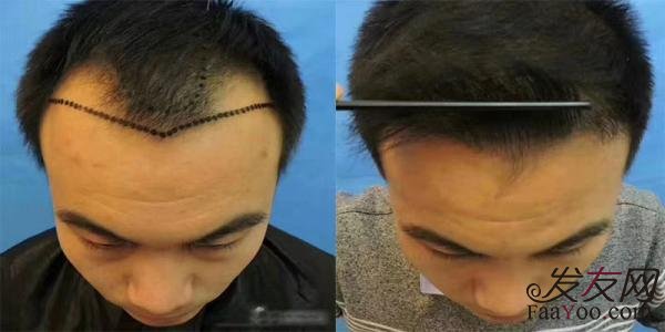 补发和植发一样吗?
