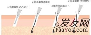毛囊成活率受那些因素的影响呢?