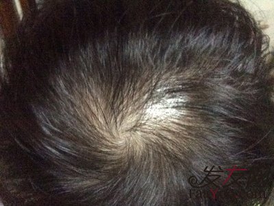 苏玫氏头发纤维粉