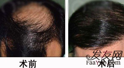 植发之后怎么判断头发长的好不好?