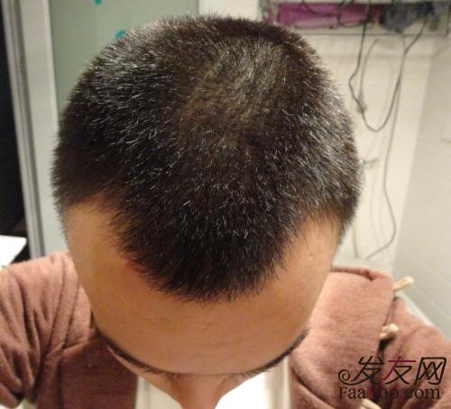 植发之后怎么判断头发长的好不好?