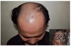 植发后期的效果能永久保持吗？