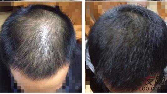 植发会影响原生发的生长吗？
