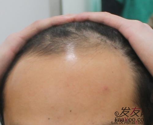 脂溢性脱发人群做植发能行吗?