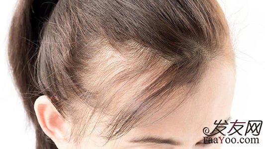 挽救女性脱发的方法有哪些？