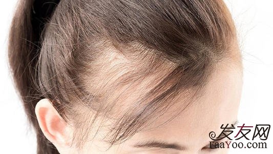 挽救女性脱发的方法有哪些?