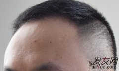 哪种脱发不需要去植发？
