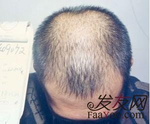 脂溢性脱发怎样才能治好?
